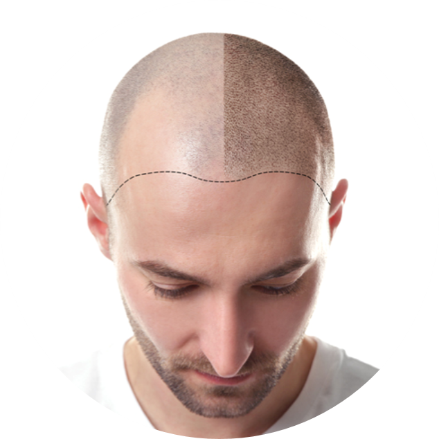 HAIR TRANSPLANTATION