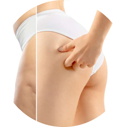 CELLULITE REDUCTION