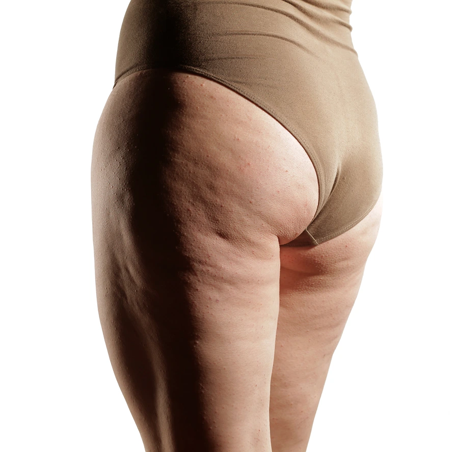 Benefits of Cellulite Reduction Treatments McKinney, Texas Banner