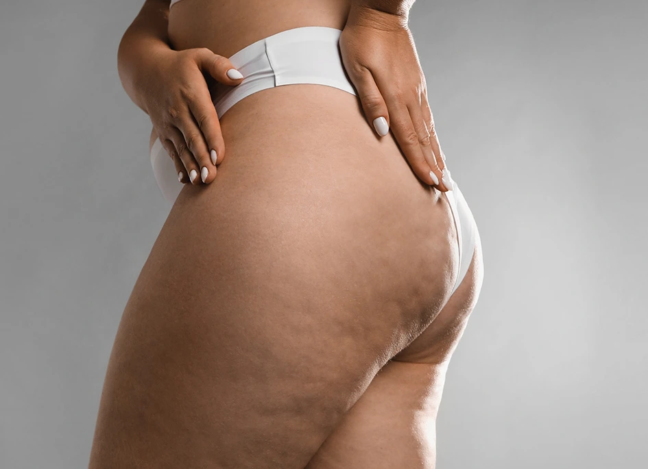 Cellulite Reduction in McKinney, TX Banner