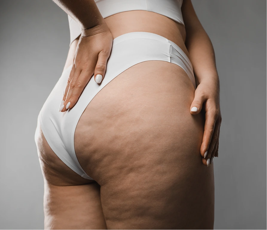 What Is Cellulite Reduction In McKinney, TX Banner